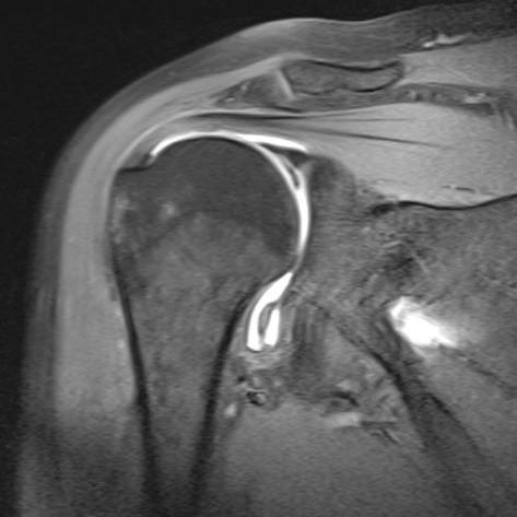 Direkte kontrastverstärkte MRT-Arthrografie Schulter